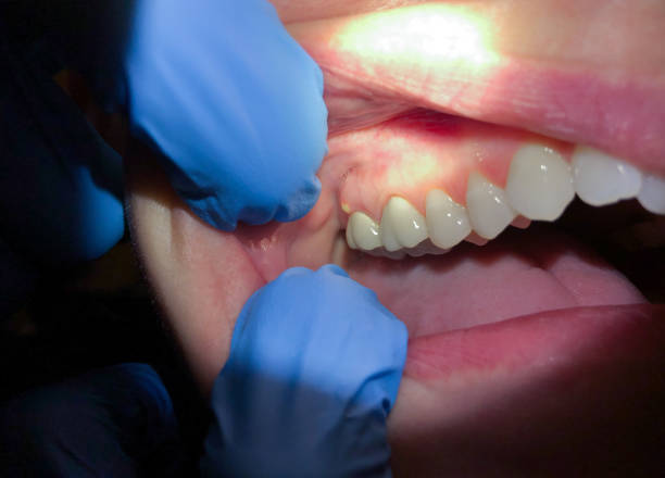 Best Emergency Wisdom Teeth Removal in West Odessa, TX
